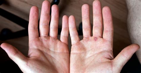 Corns and calluses are thick, hardened layers of skin that develop when your skin tries to protect itself against friction and pressure. 5 Tips on How to Control Your Calluses