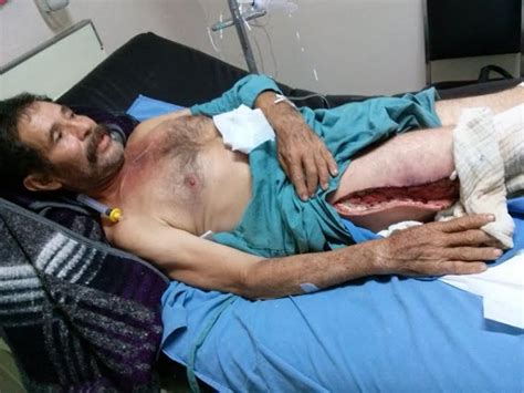 Sus picaduras pueden ulcerarse hasta tal punto, que acaban por destruir por completo la piel del brazo o la pierna donde la araña mordió. Hombre denunciará al hospital general de Tierra Blanca por ...
