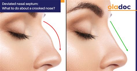 A deviated septum is a condition that impacts the nasal septum and affects our breathing. Deviated Nasal Septum: What to Do About a Crooked Nose ...