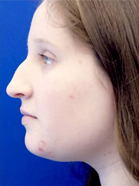While you want to get rid of the bump in your nose, you don't want. Reduction Dorsal Hump - Mao Facial Plastics