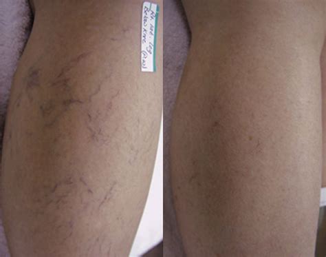 It is commonly used in the treatment of varicose and spider veins of the leg. Sclerotherapy Treatment | Sclerotherapy Treatment Near Me