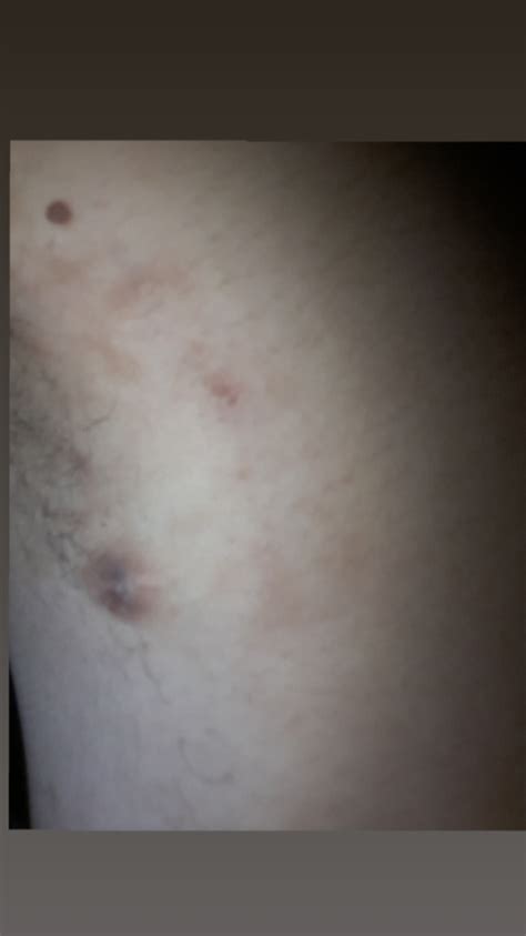 Skin tag (medical term is acrochordon) is a small benign tumo. Lump !! Help please | Cancer | Forums | Patient