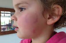 old girl scratched year bite face child mark neck bruised toddler kid shocking older her injuries left after scroll while