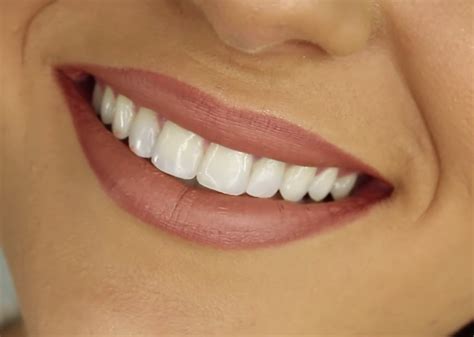 Plaque can get worse over time. Will Teeth Whitening Remove Tartar? | Dental Planet
