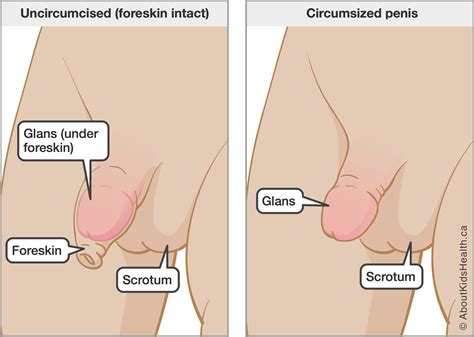 Circumcision in newborns
