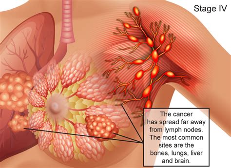 In particular, it focuses on how big it is and how far it has spread throughout the body. Breast Cancer Stages, Stage IV: The cancer has spread far ...