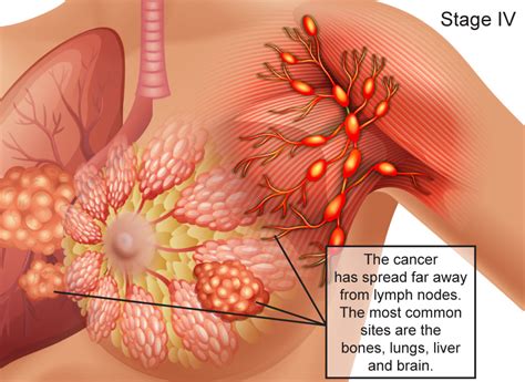 Learn how pathologists stage breast cancer according to the appearance and spread of malignant cells. Breast Cancer Stages, Stage IV: The cancer has spread far ...