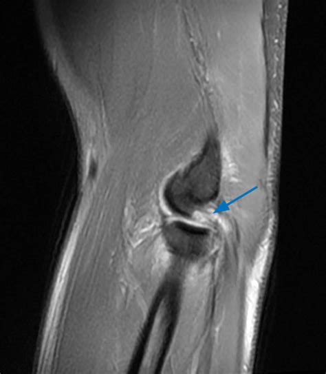 A grade 3 mcl tear often occurs along with a tear of the anterior cruciate ligament. Posteromedial Rotatory Instability of the Elbow - Radsource