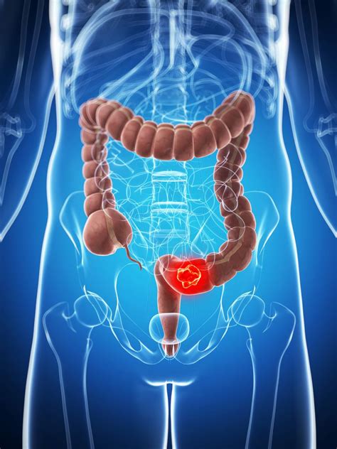 Even after seemingly effective treatments, crafty cancer screening is recommended to find the polyps before they become cancerous, according to the mayo clinic. A Closer Look at the Top 5 Deadliest Cancers