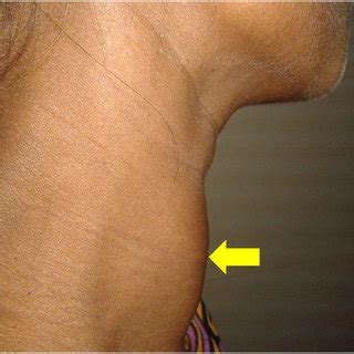 With graves' disease, the entire thyroid is involved, so the iodine shows up throughout the gland. (PDF) Graves' disease presenting as bi - Ventricular heart ...