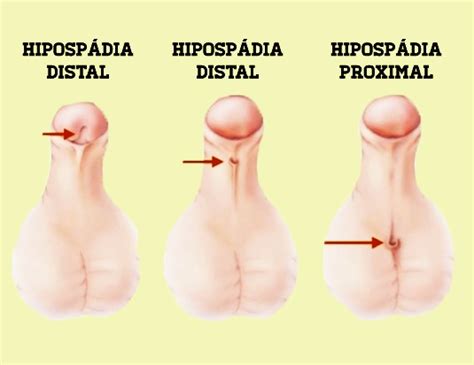 Hypospadias repair is being performed at progressively younger ages. Hipospadias. ¿Cuáles son las causas? - Dr. Boris Camacho ...