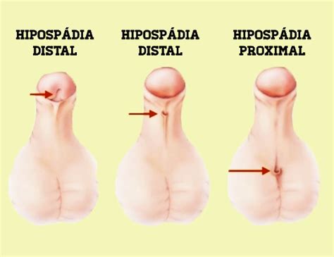 Basuguy and mehmet şerif arslan and s. Hipospadias. ¿Cuáles son las causas? - Dr. Boris Camacho ...