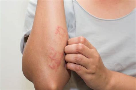 Need to know how to get rid of eczema scarring? How to Get Rid of Eczema Scars Naturally at Home?