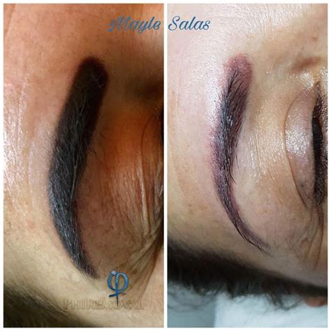 The total number of laser tattoo removal sessions you will require depends the type of. Eyebrow removal procedure! This is an amazing result from ...