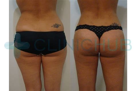 Visit dennis dass md office in beverly hills ca. Brazilian Buttock Lift BBL Turkey Before and After Photos ...