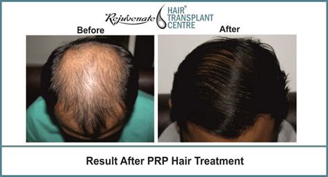 What are the steps involved in ahsct procedure? Pin on Best Hair Transplant Centre in India