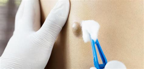 A biopsy is a medical test commonly performed by a surgeon, interventional radiologist, or an interventional cardiologist. What to Expect From a Skin Biopsy: Elvira Klause, MD, FACS ...