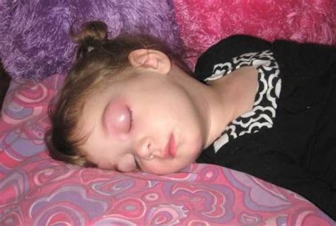 Can a person with skeeter syndrome get a fever? Pin on maddie
