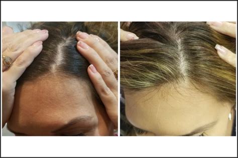 Inflammation is one of the reasons why we lose hair. PRP Injection for Hair Loss - Majestic Beauty Spa PLLC