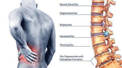 Lower right back pain occurs suddenly and can range from mild to severe. Right Side Back Pain: Causes and Treatment