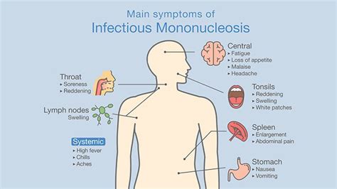 Could go to the iliac crest. How You Know You Have Mononucleosis | Everyday Health