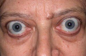 Graves' eye disease, also called graves' ophthalmopathy or thyroid eye disease, is a problem that usually develops in people with an overactive thyroid caused by graves' disease (see brochure on graves' disease). Grave's Disease • Aesthetic & Reconstructive Oculoplastic ...