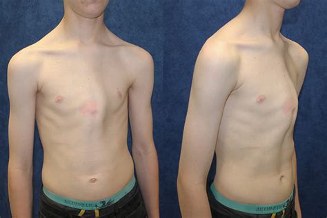 Pectus excavatum is a congenital, concave deformity of the caudal sternum that results in a reduced ventrodorsal thoracic diameter.1,2 the cause is unknown, although a hereditary component has been suggested.3 pectus excavatum can result in compromised pulmonary and cardiac function due to. Chest bracing works wonders for teenage pectus carinatum ...