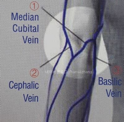 Enlarged median cubital vein and smaller vein joining it in the right arm. 정맥채혈방법 - 1. 정맥채혈부위와 부적합부위, Vacutainer로 채혈하는 방법 : 네이버 블로그