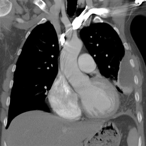 Patients most commonly present with dyspnea, initially on exertion, predominantly dry cough, and pleuritic chest pain. Large, Loculated Pleural Effusion 2 of 3