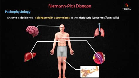 These cells malfunction and, over time, die. Niemann-Pick Disease - Case Based discussion , Usmle step ...