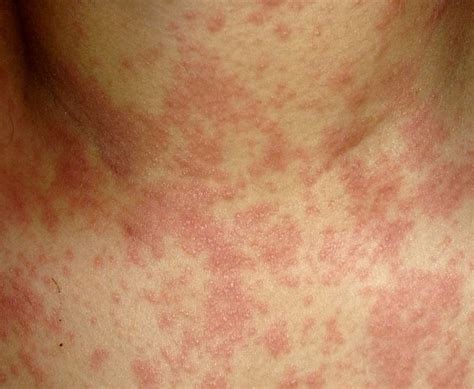 Il Benessere Sa Di Casa: rimedi naturali sul prurito nel corpo