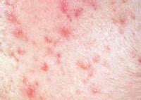Pimples are very common problem all over the world. 2012 January Page 30