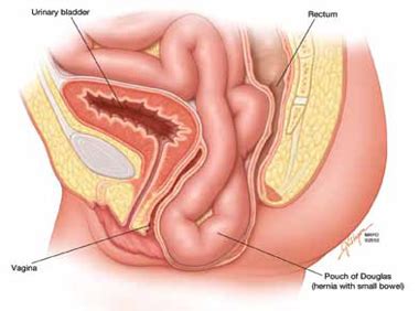 Pouch of douglas is a peritoneal fold present behind the uterus. When is her pelvic pressure and bulge due to Pouch of ...