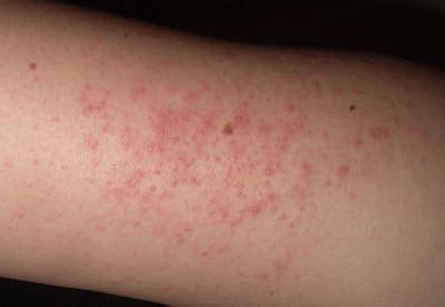 Nässelutslag (urtikaria) är ett slags hudutslag som ger en vitaktig hudsvullnad med röd omgivning. Hudspecialisten » Så här behandlar du Keratosis Pilaris