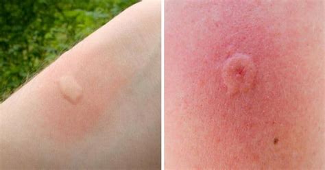 Traci duncan, a nurse practitioner at children's of alabama's dermatology clinic, walks us through six summer skin issues and how to treat them. 10 insect bites/stings that you should learn to recognize ...