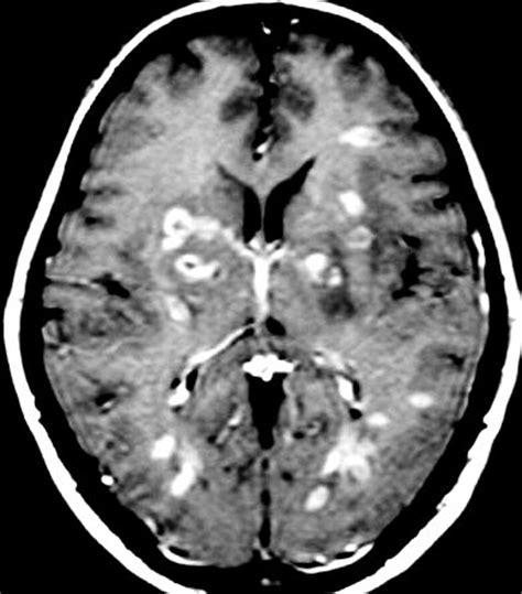 A ressonância magnética (rm) é um exame de imagem fundamental para o diagnóstico da em, pois permite a na imagem acima vemos um exame de ressonância do crânio onde observamos múltiplos pontos brancos representando as áreas de inflamação provocadas pela esclerose múltipla. Neupatimagem-UNICAMP