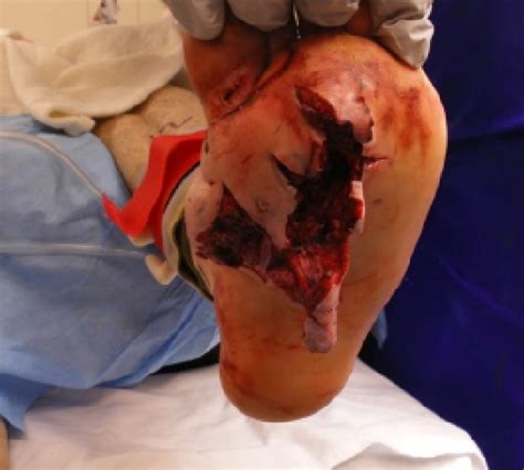 I'm not sure the word wound and 50 caliber go together. 50 Cal Bullet Wound Pics - Can Someone Survive A 50 Cal ...