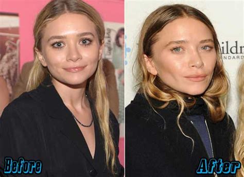 Elizabeth chase olsen is an american actress. Top 6 Celebrity Before and After Plastic Surgery - Plastic ...