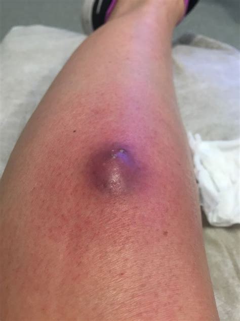 For your iphone, ipad, or ipod touch with ibooks and on your computer. False widow spider bite hospitalises mum - leaving her ...