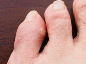 Types of corns on feet. What are corns and callus? - The Foot & Ankle Clinic
