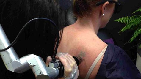 Your trusted tattoo removal clinic in newcastle laser tattoo removal is a safe and effective way of permanently removing a tattoo. Tattoo Laser Removal Newcastle - tattoo removal tattoo ...