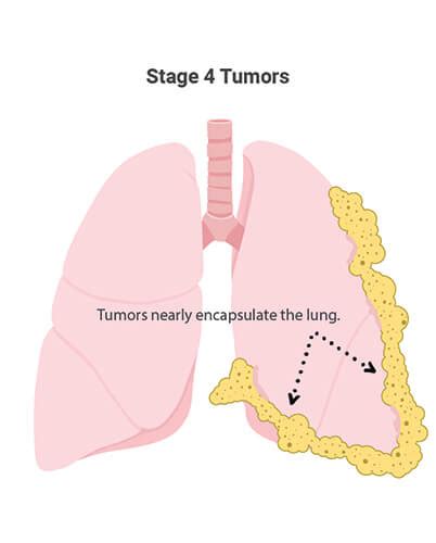 This is often shortened to just mesothelioma. Mesothelioma: What Is Malignant Mesothelioma Cancer?