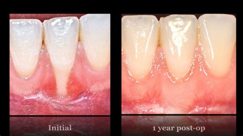 She earned her dmd at the medical university of south carolina in 2007 and received her certification in periodontics from the university of alabama at birmingham (uab) in 2010. Smile Gallery - Before and After Dental Photos - Smile ...