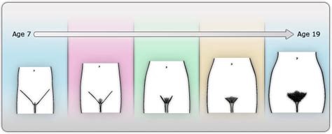 This stage of pubic hair (tanner ii) appeared in the boys investigated by us at a median age of 12 years, which corresponds with data from the national health and nutrition examination survey iii. PUBIC HAIR DEVELOPMENT