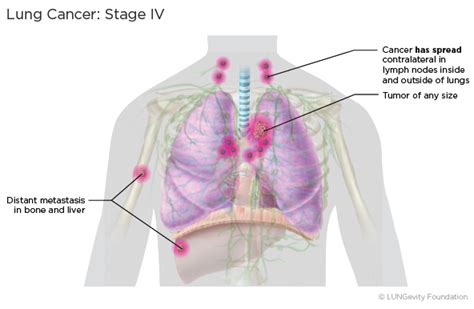 Chemotherapy is a common treatment to help slow the spread of the disease—as left untreated, the average life expectancy for dogs after diagnosis under three months. Metastatic Lung Cancer Life Expectancy