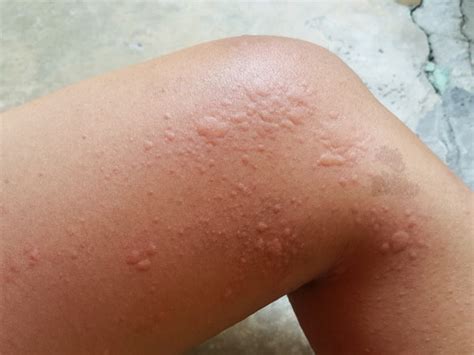 Urticaria has a lifetime prevalence of approximately 20 percent in the general population. Homeopathic remedies for urticaria (hives) | Manage ...