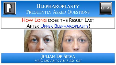 Slate is one of the few roofing options that doesn't need to be replaced within the span of a lifetime. HOW LONG does the result last after Upper Blepharoplasty ...