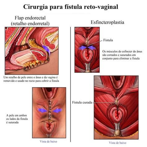 5501 high definition videos are available for you. Fístula anal e perianal, sintomas, cirurgia, prognóstico e ...