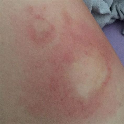 Bei der röschenflechte (pityriasis rosea) bildet sich ein juckender hautausschlag, der sich vom rumpf bis zu oberarmen und oberschenkeln erstrecken kann. Brennender Juckreiz, was tun/was kann das sein? (Ausschlag)