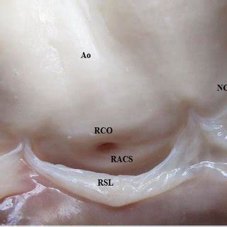 The coronary sinus is a large vein located in the coronary sulcus of the heart. (PDF) Gross morphology and morphometry of coronary ...